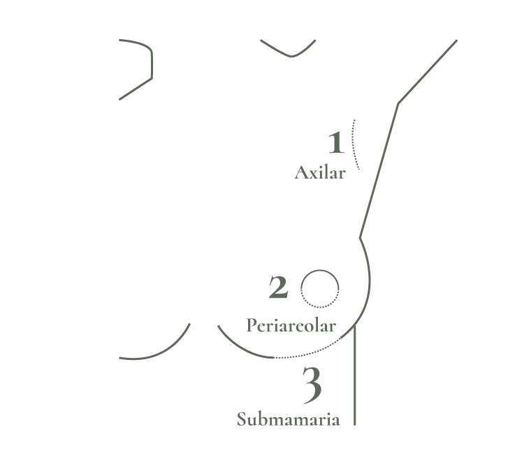 incisiones-protesis-mamarias incisiones-protesis-mamarias