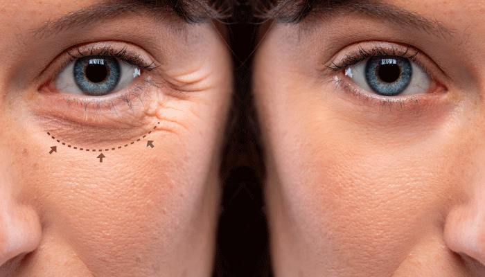 Blefaroplastia, despídete de la mirada cansada