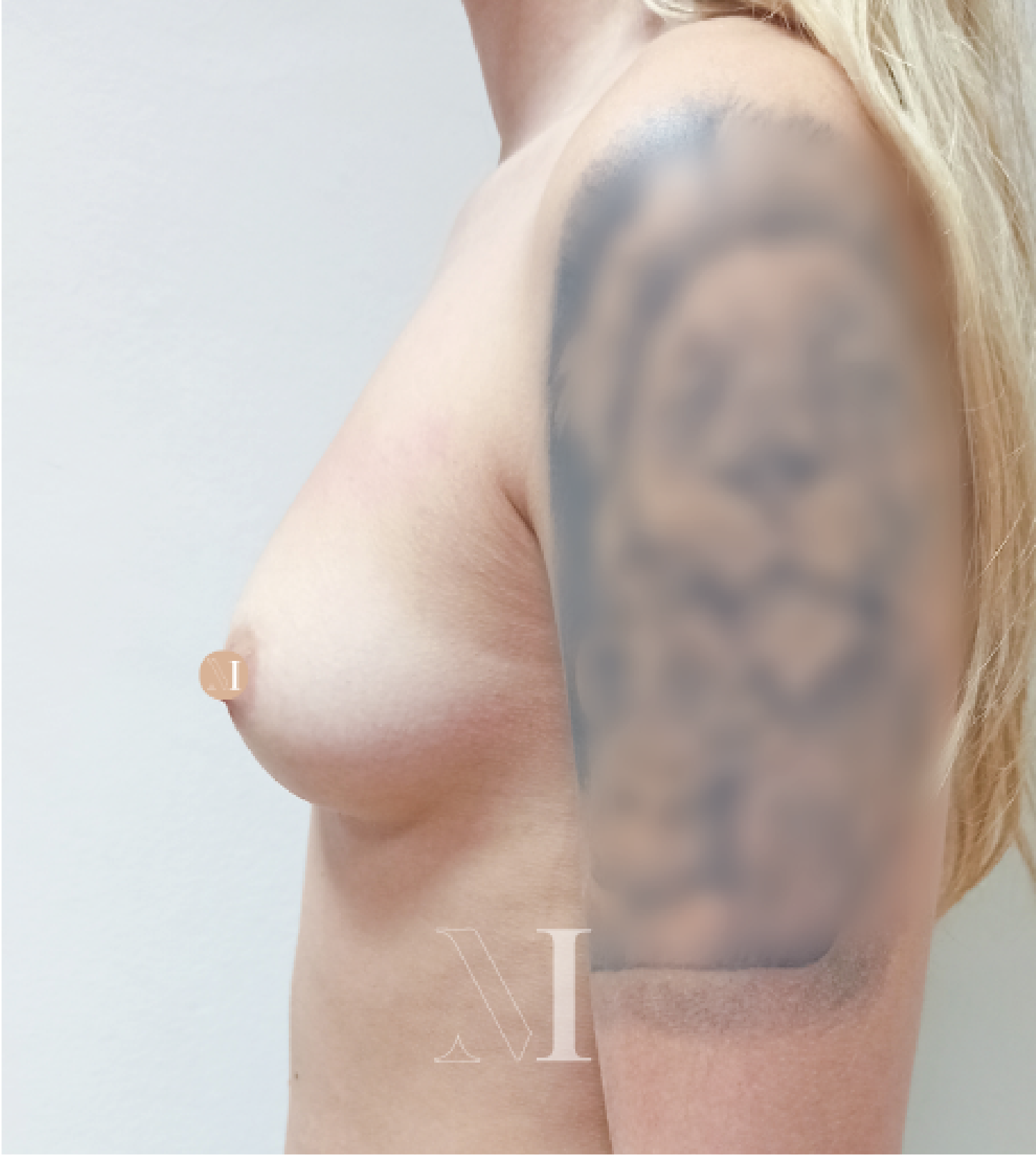 aumento-mamas-ejemplo3-22