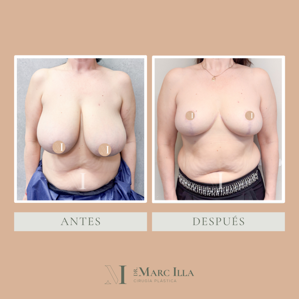 Reducción de mamas
