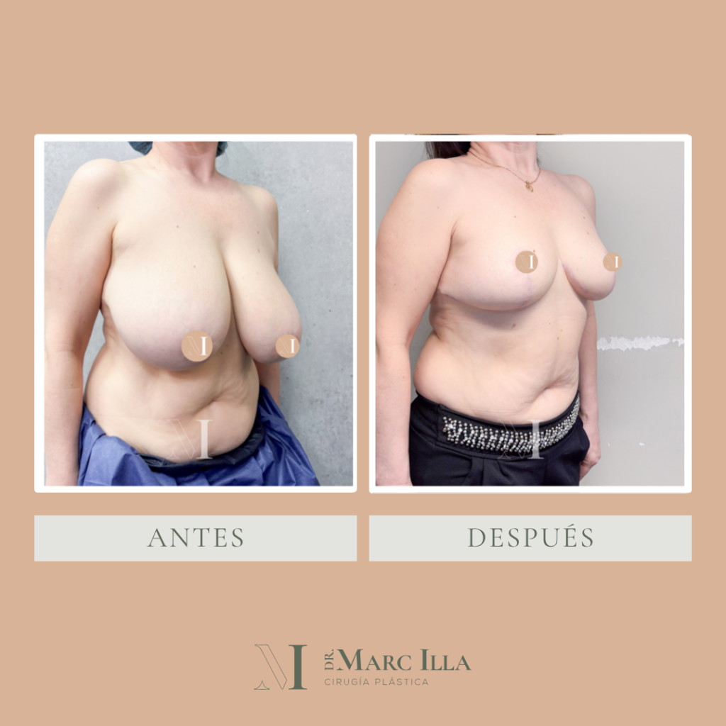 Reducción de mamas