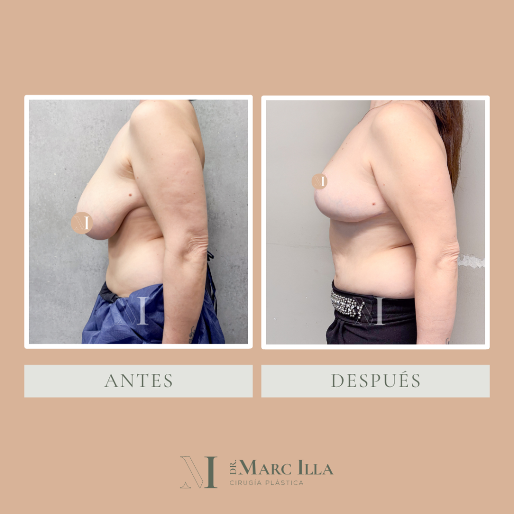 Reducción de mamas