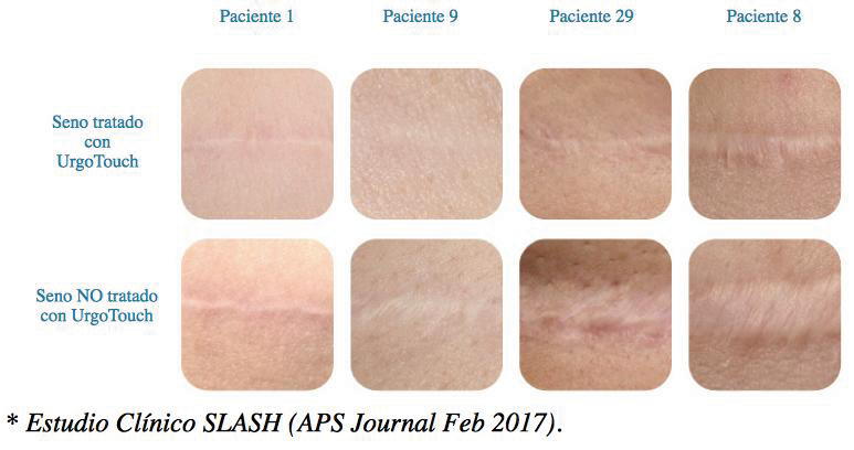 láser Urgotouch® resultados